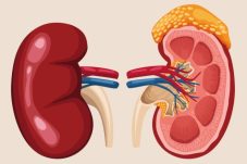 Ilustrasi ginjal manusia yang terinfeksi TB ginjal, penyakit yang dikaitkan dengan kasus meninggalnya Lucky Element